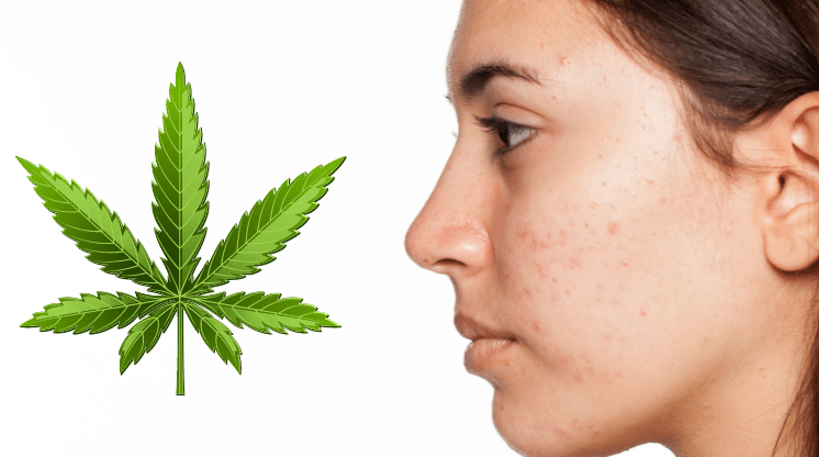 can weed make your skin break out